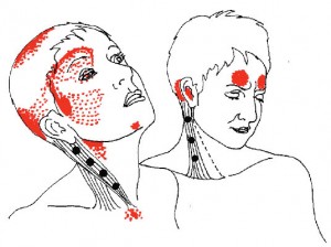 Trigger Point Diagram